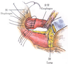 示意图7:缝合膈食管韧带游离缘与膈肌裂孔