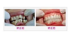 美容冠前后对比图 美容冠前后对比图